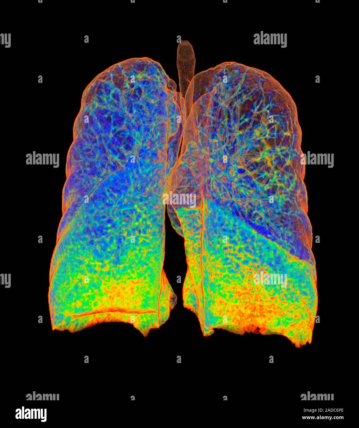 Smoker's lungs and emphysema. Digitally enhanced 3D computed tomography