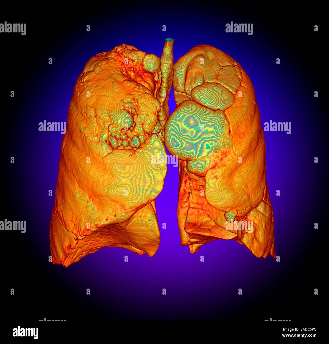 Smoker's lungs and emphysema. Digitally enhanced 3D computed tomography
