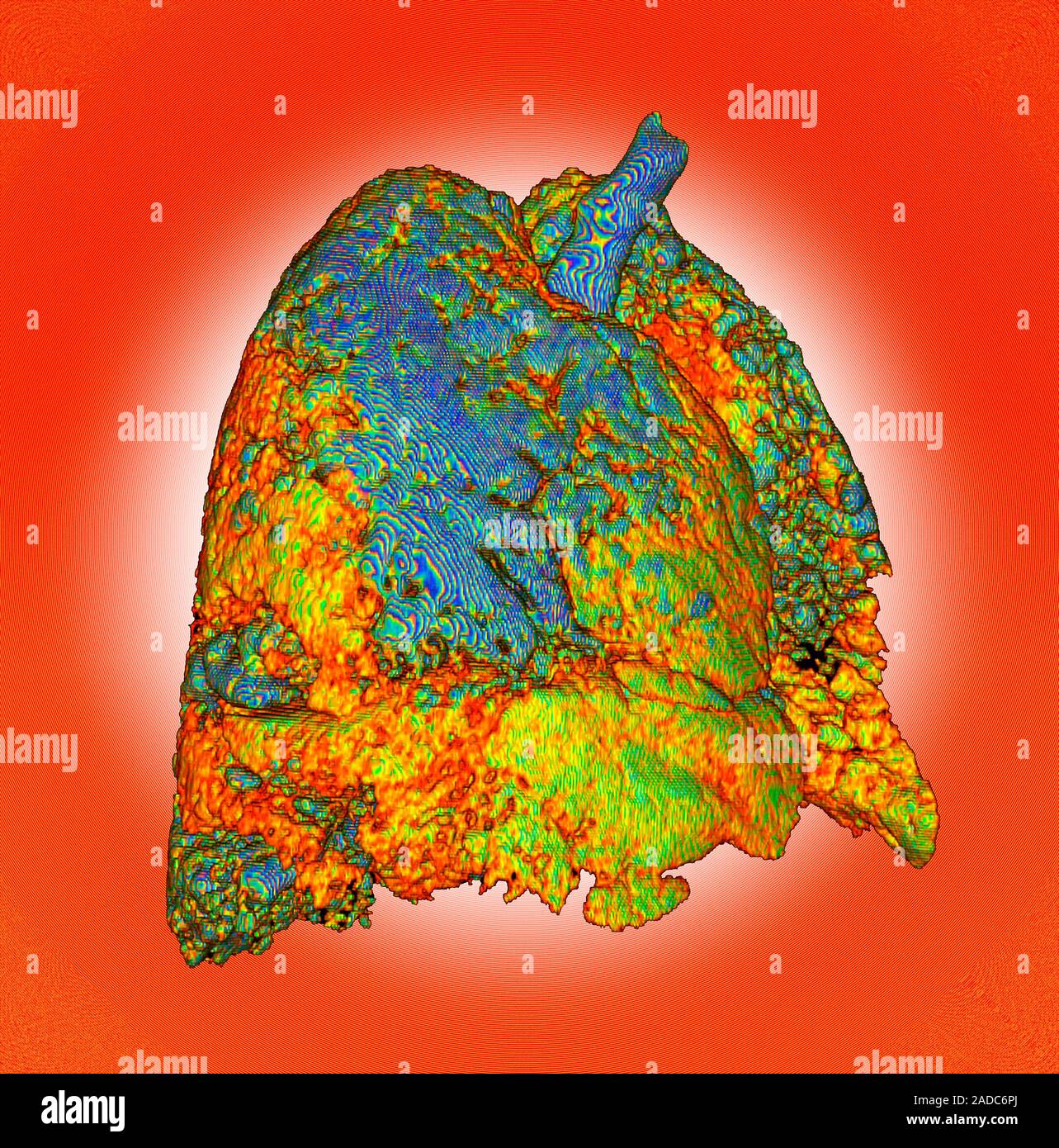 Interstitial lung disease with pulmonary fibrosis. Digitally enhanced ...