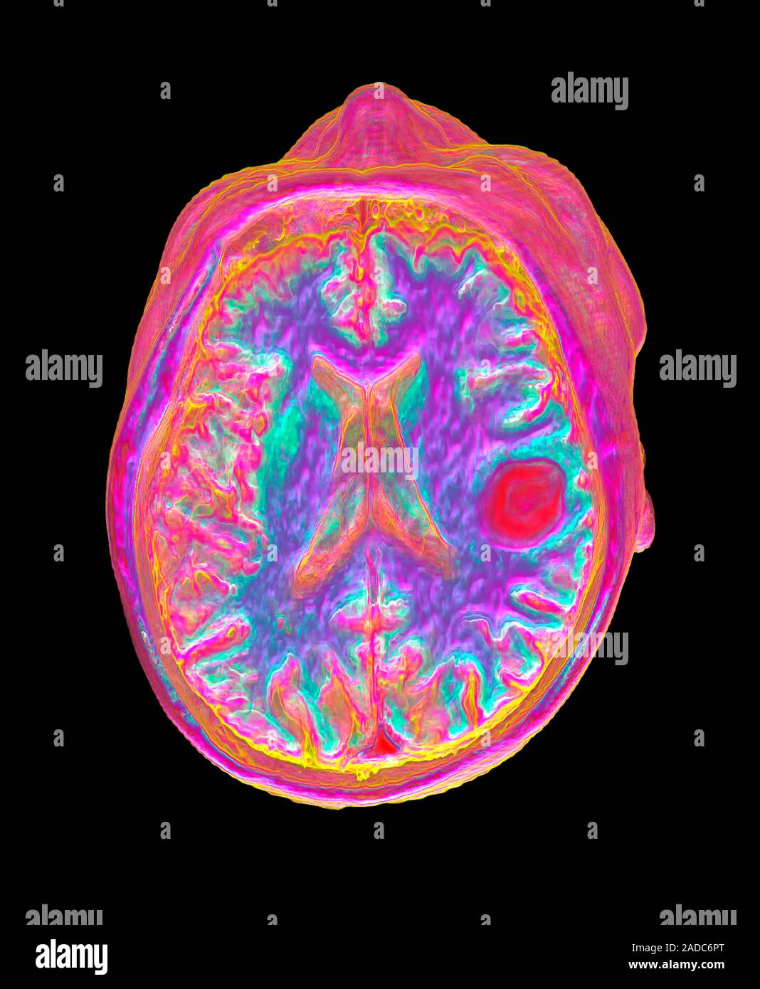 Stroke due to blood clot. Digitally enhanced 3D resonance