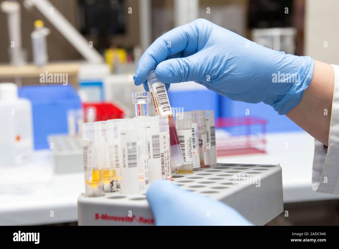 Blood sample analysis. Blood samples being analysed in a medical laboratory. These blood samples