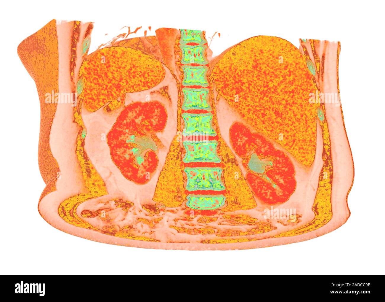 Liver and spleen and kidneys, 3D coloured computed tomography (CT) scan