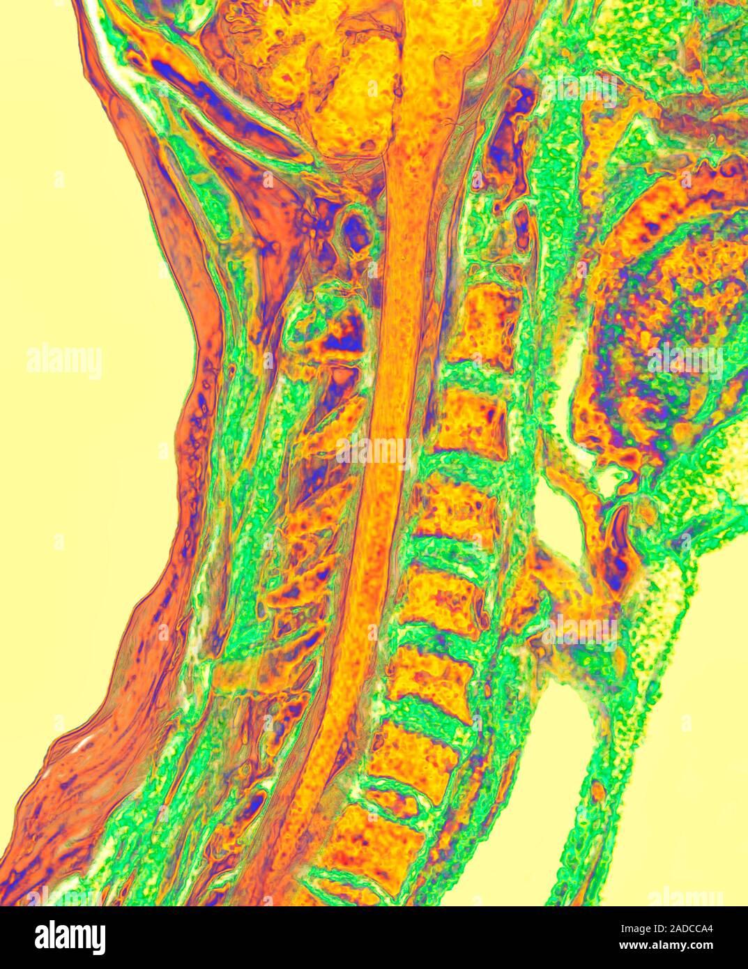 Upper spinal cord and vertebrae, 3D coloured magnetic resonance imaging ...