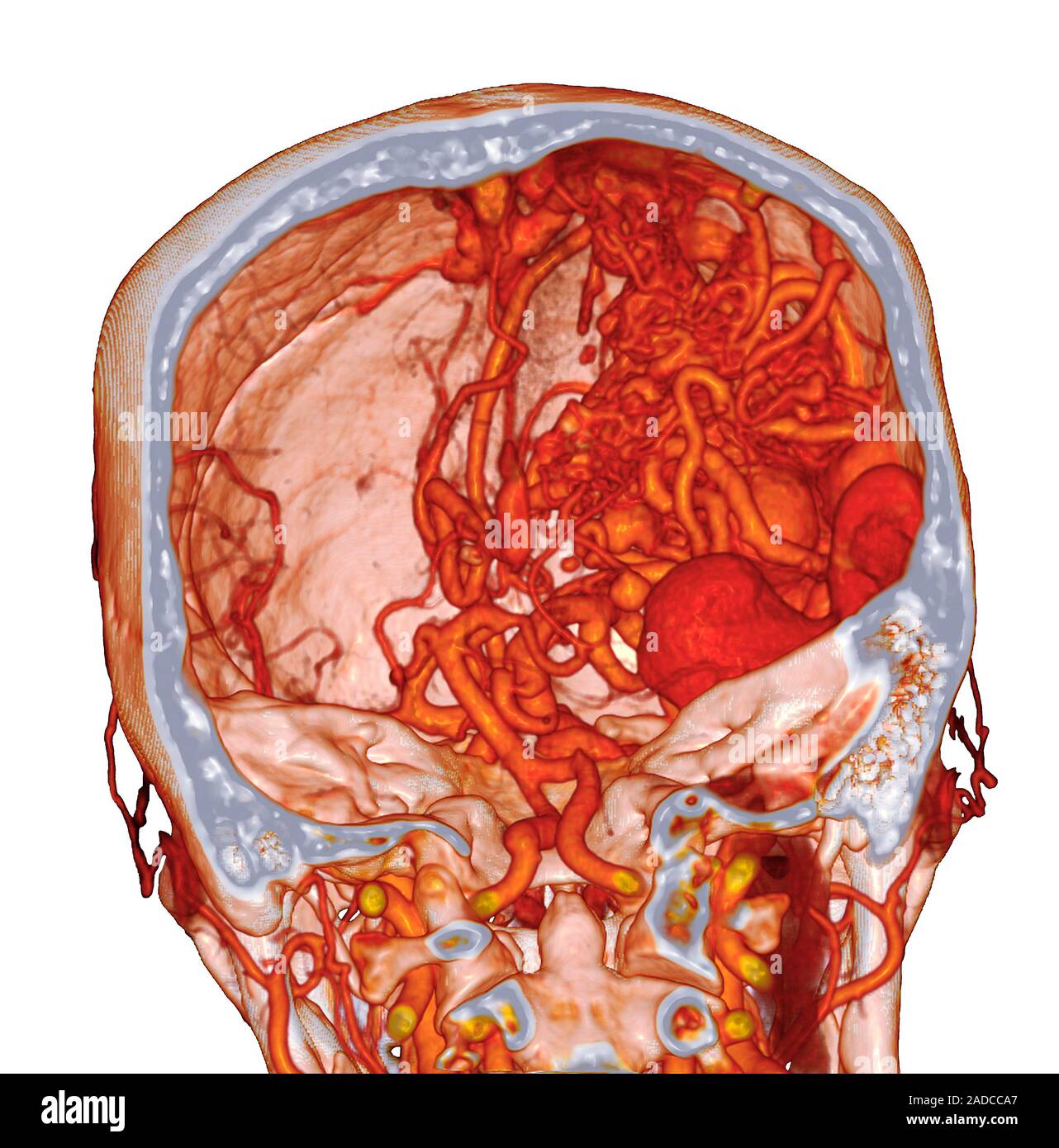 Cerebral arteriovenous malformation. Coloured 3D computed tomography ...