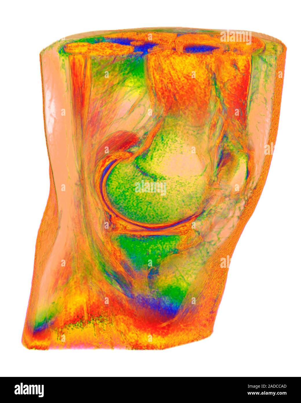 Human knee, 3D coloured resonance imaging (MRI) scan. This