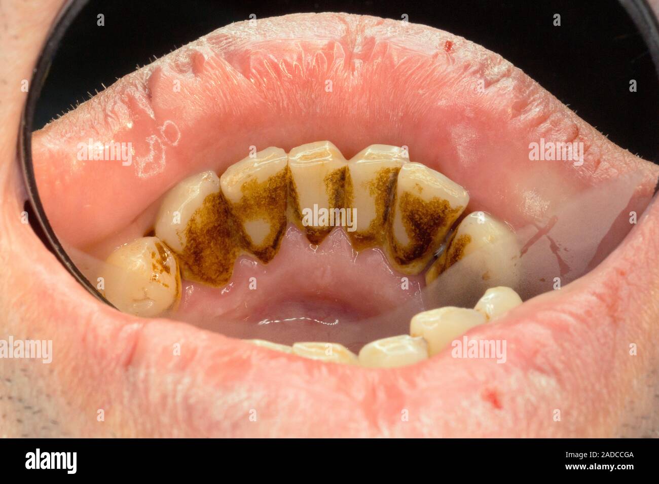 Tartar (calculus) on teeth. Closeup of the lower teeth of a 30year