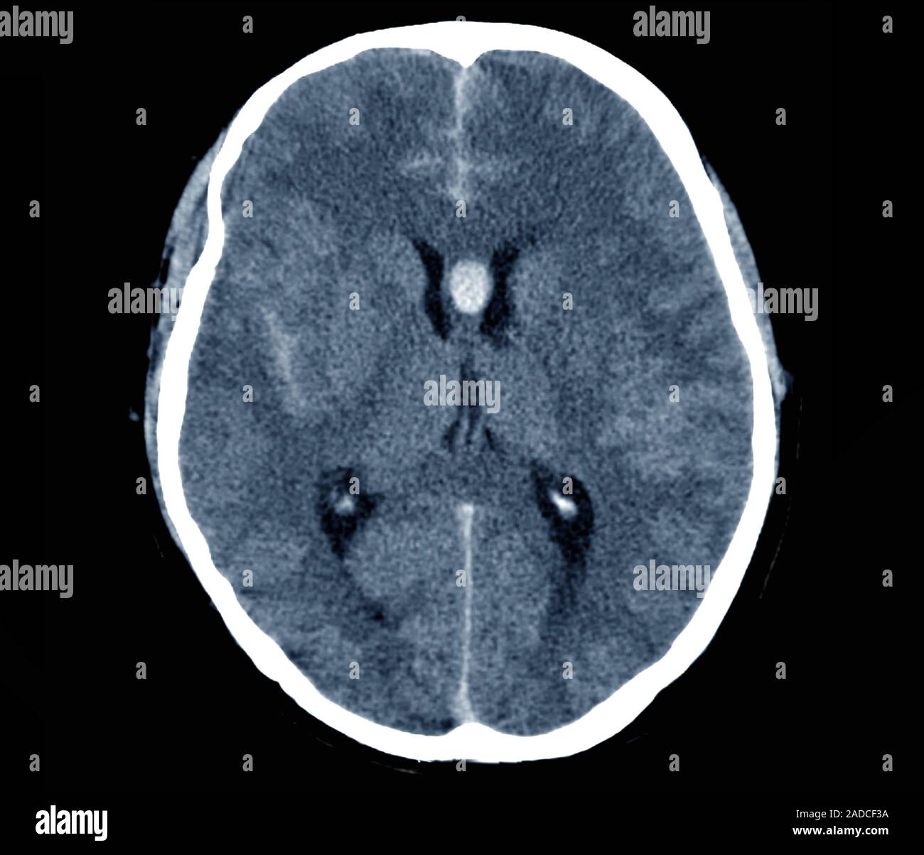 Brain haemorrhage. Axial computed tomography (CT) scan through the ...