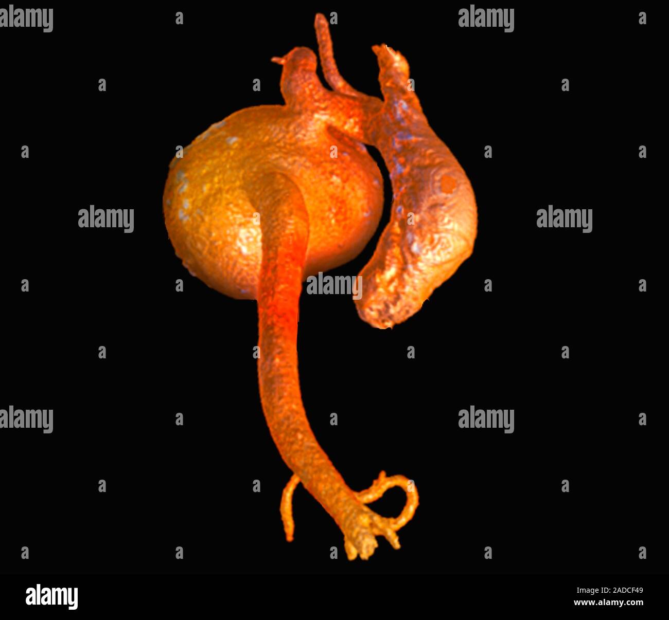 Aortic aneurysm. 3D computed tomography (CT) angiogram of an aneurysm