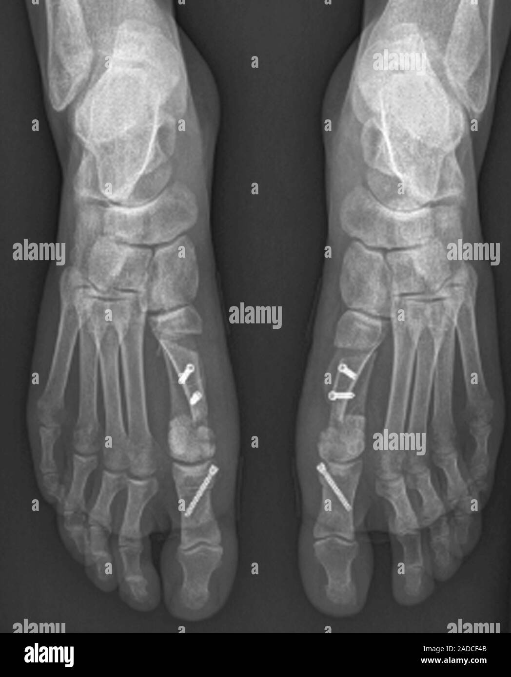 Bunion surgery. Bilateral frontal Xray of the feet of a 24yearold