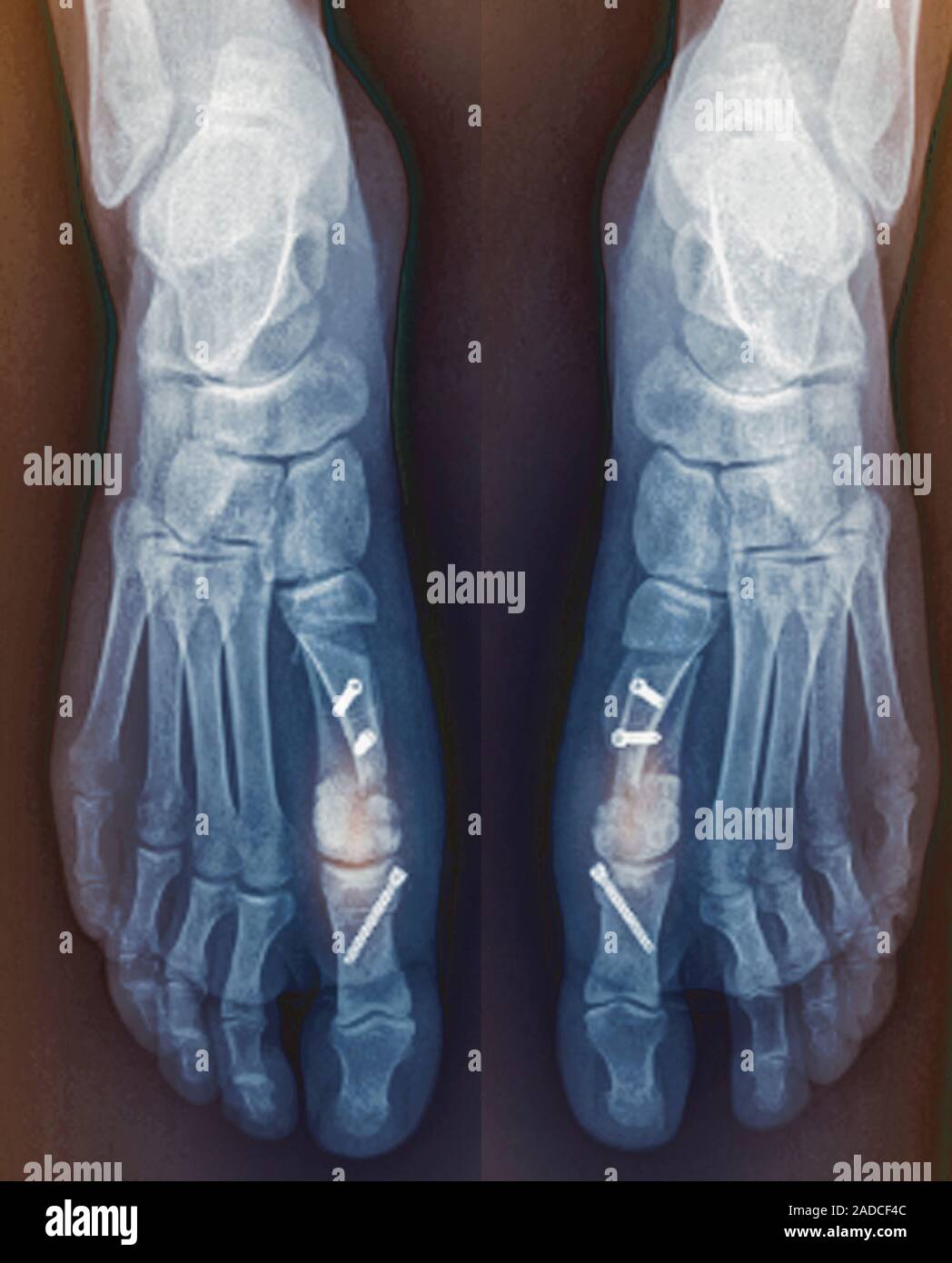 Bunion surgery. Coloured bilateral frontal Xray of the feet of a 24