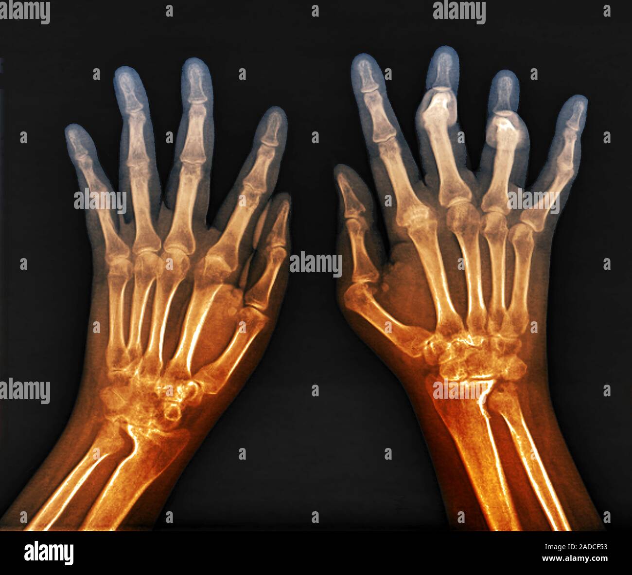 Rheumatoid arthritis of the hands. Coloured bilateral Xrays of the