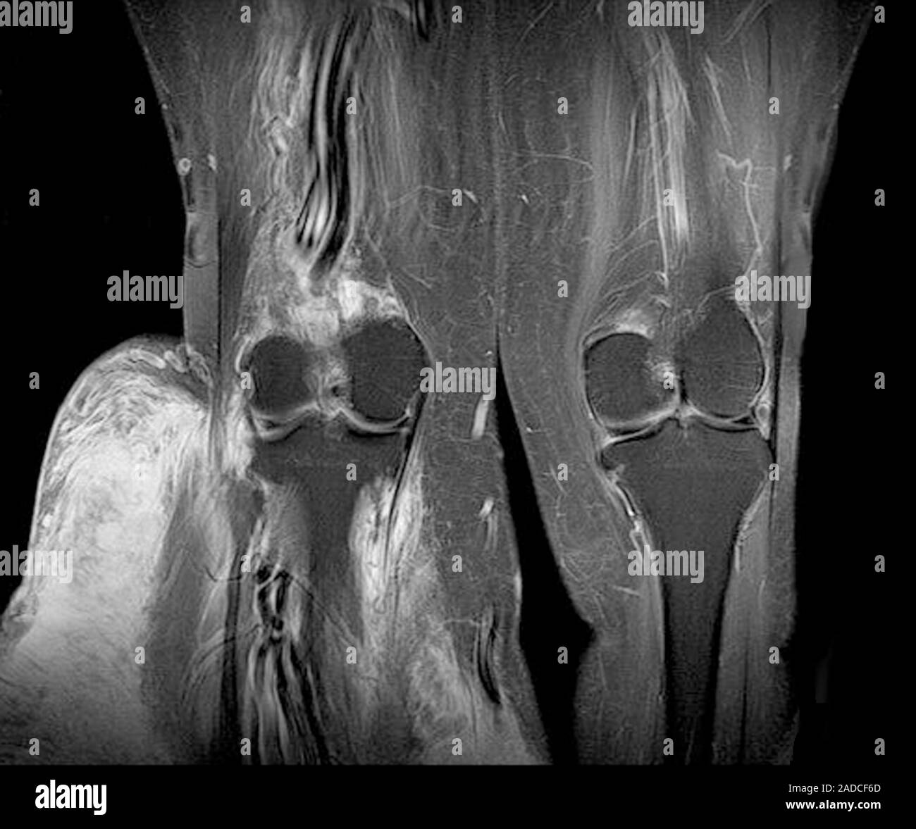 Elephantiasis of the legs. Bilateral coronal magnetic resonance imaging ...