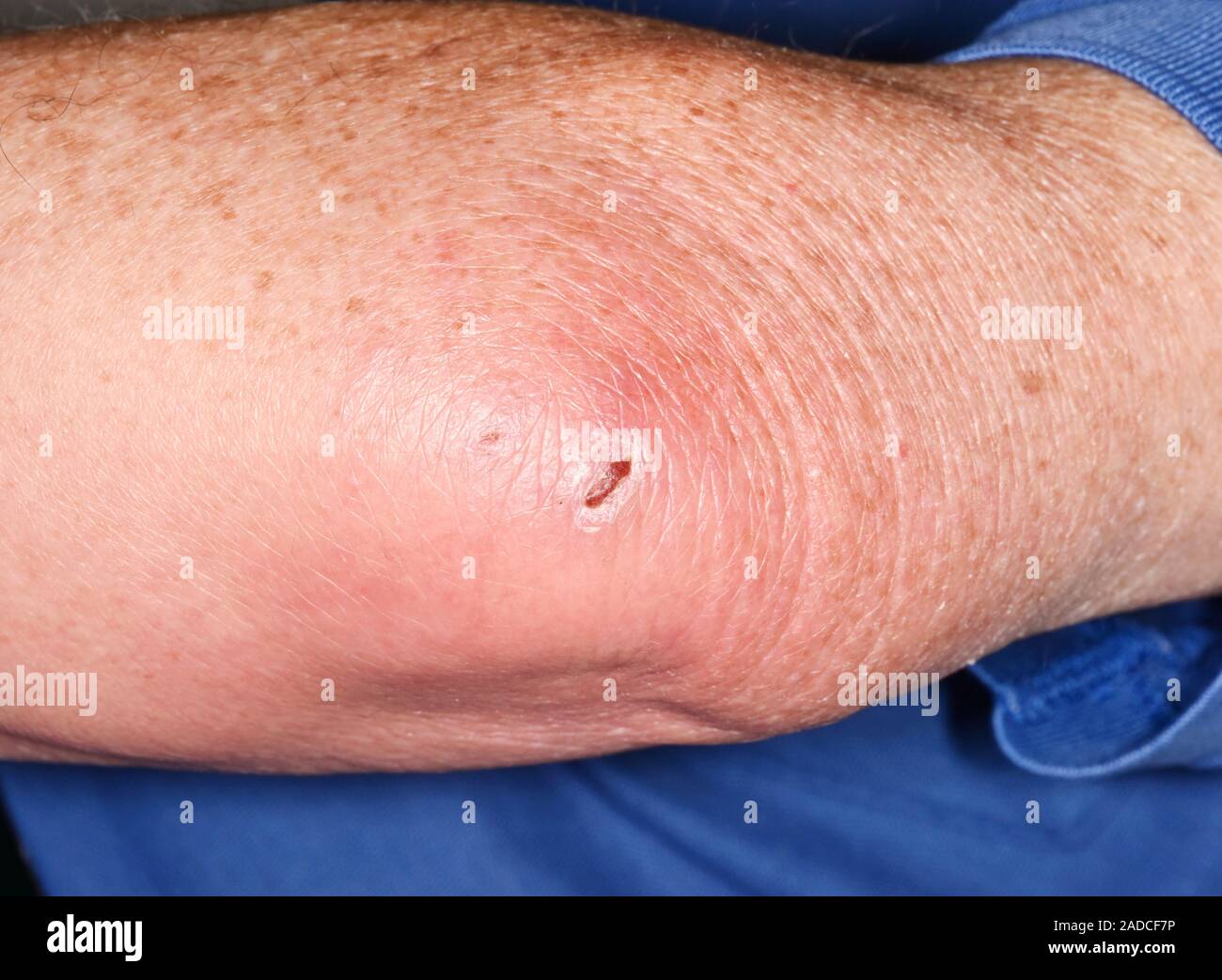 Infected olecranon bursitis in an 86yearold male patient. Olecranon
