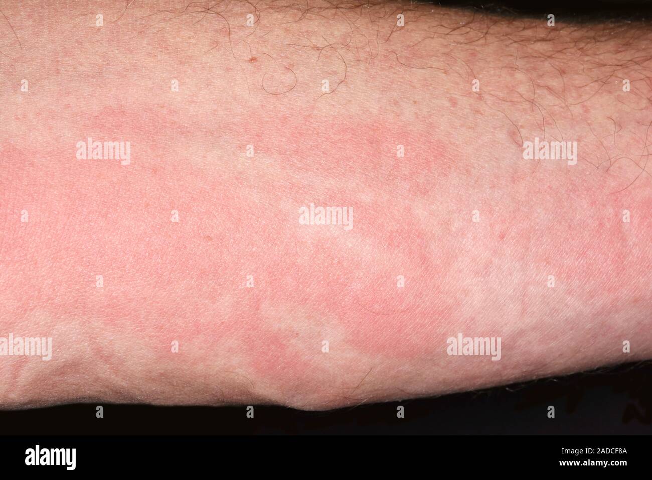 Wasp sting. Swelling and redness in the forearm of a 64yearold man