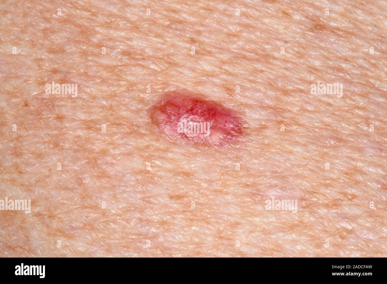 Basal cell carcinoma skin cancer. Closeup of a superficial spreading