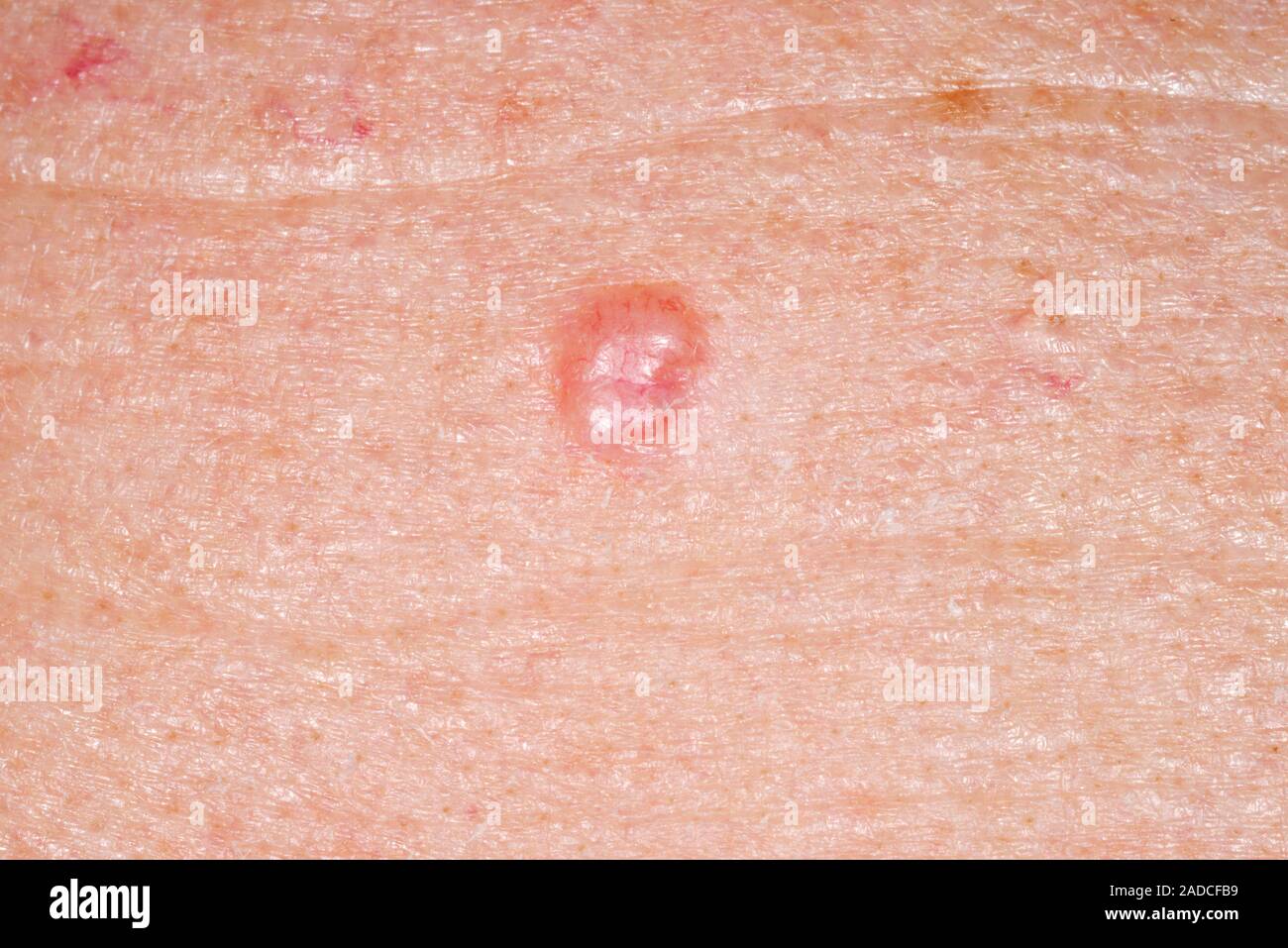 Basal cell carcinoma skin cancer. Closeup of a basal cell carcinoma