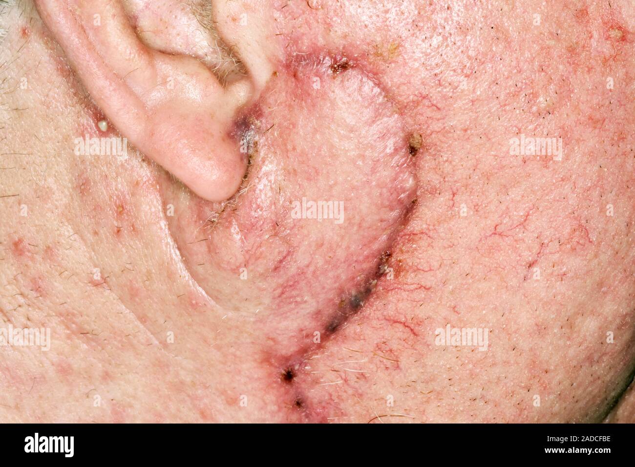 Squamous cell carcinoma skin cancer excision site. Closeup of the healing surgical site three