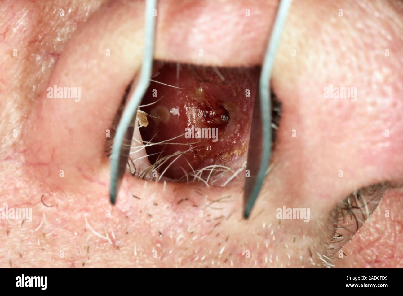 Benign (harmless) ulcer inside the nasal cavity Stock Photo Alamy