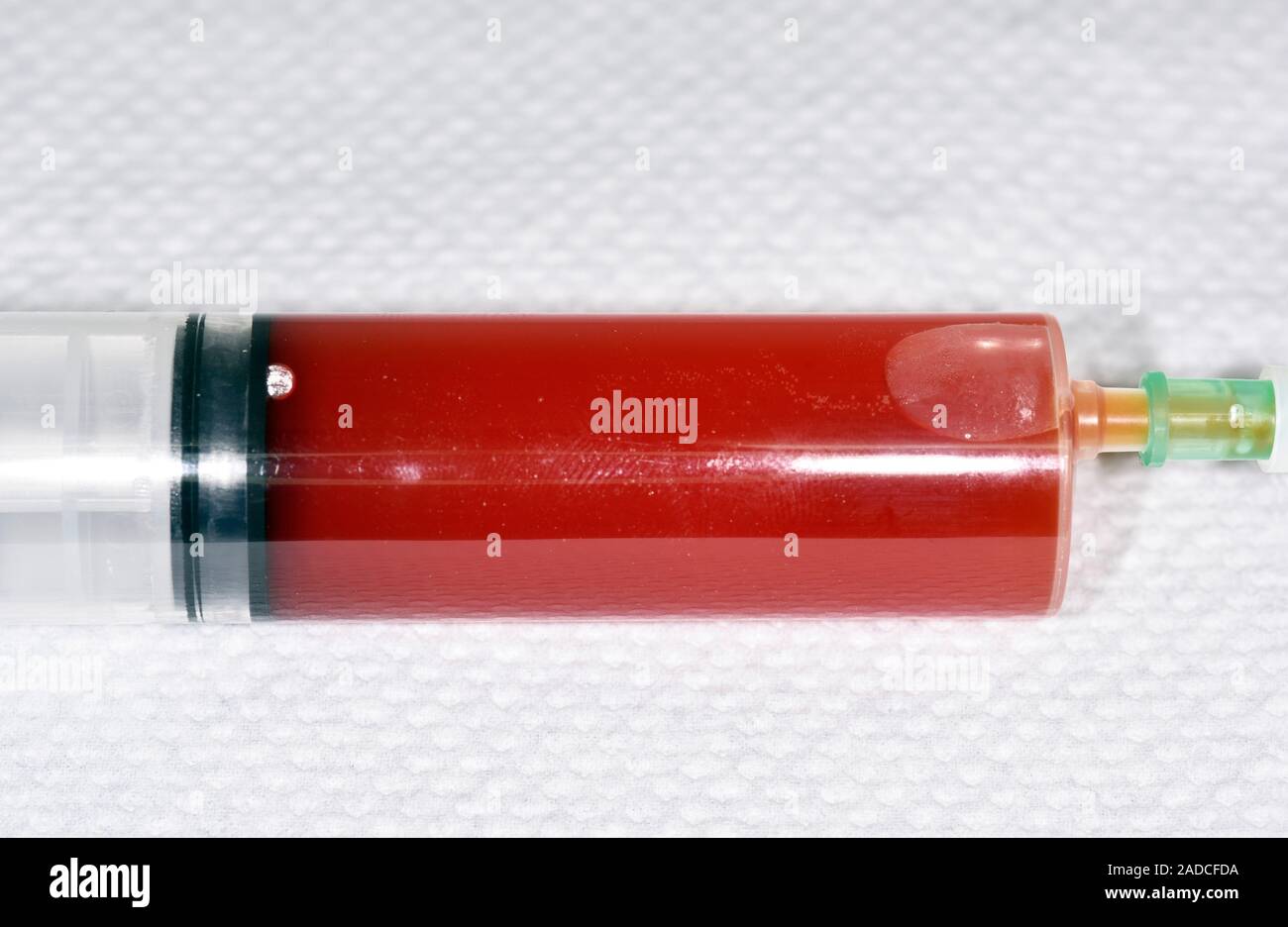 Fluid removed from knee. Syringe containing bloodstained synovial