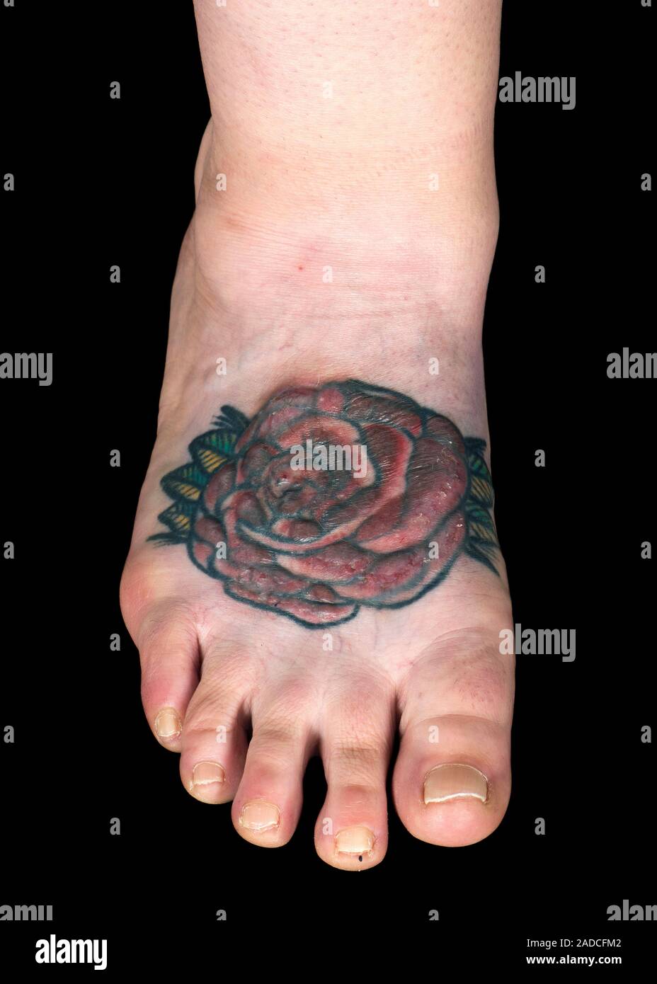 Foot of a fifty year old female patient showing a granulomatous ...