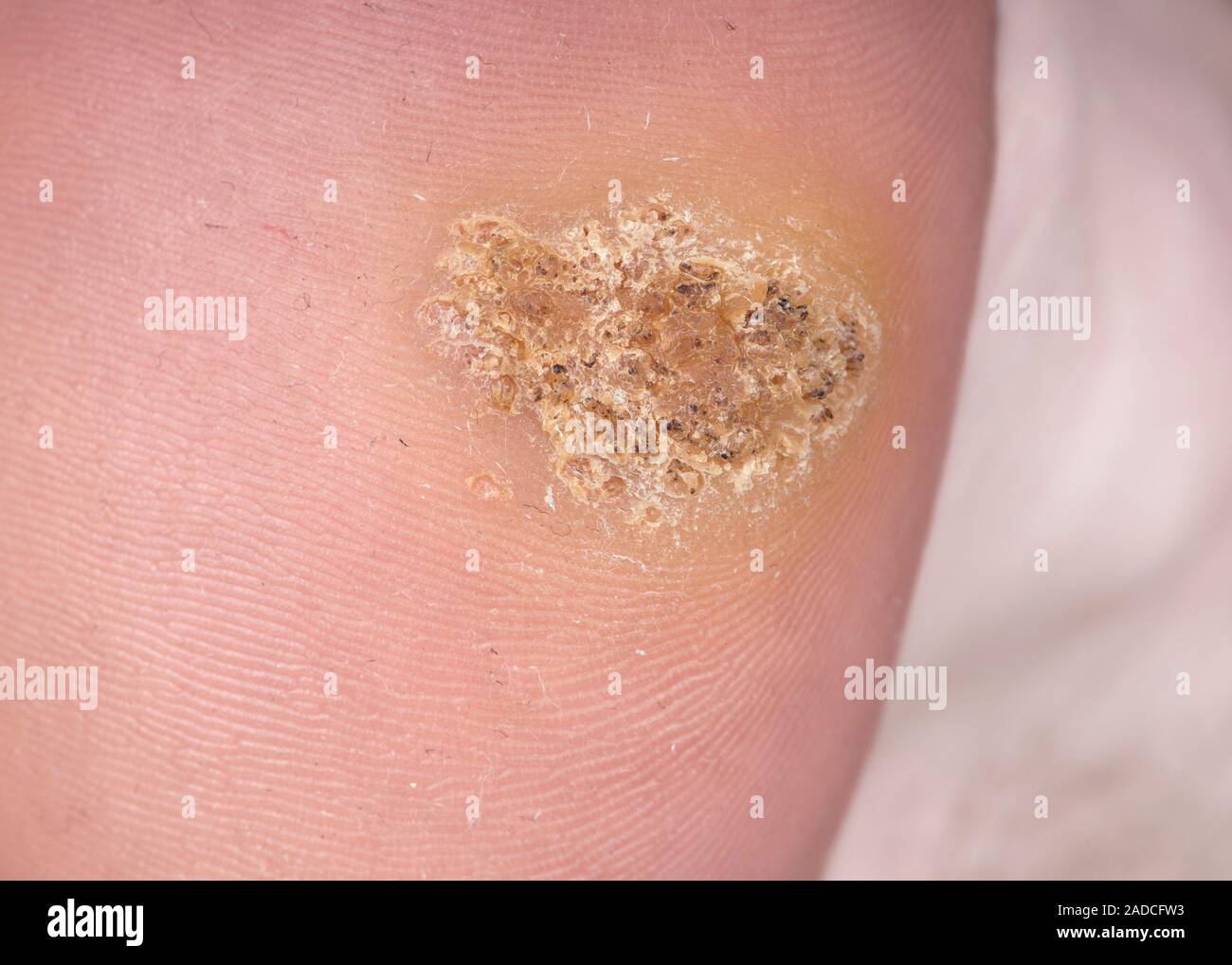 Closeup of common warts (verruca vulgaris) on the foot of a 22 year old male patient. Warts are