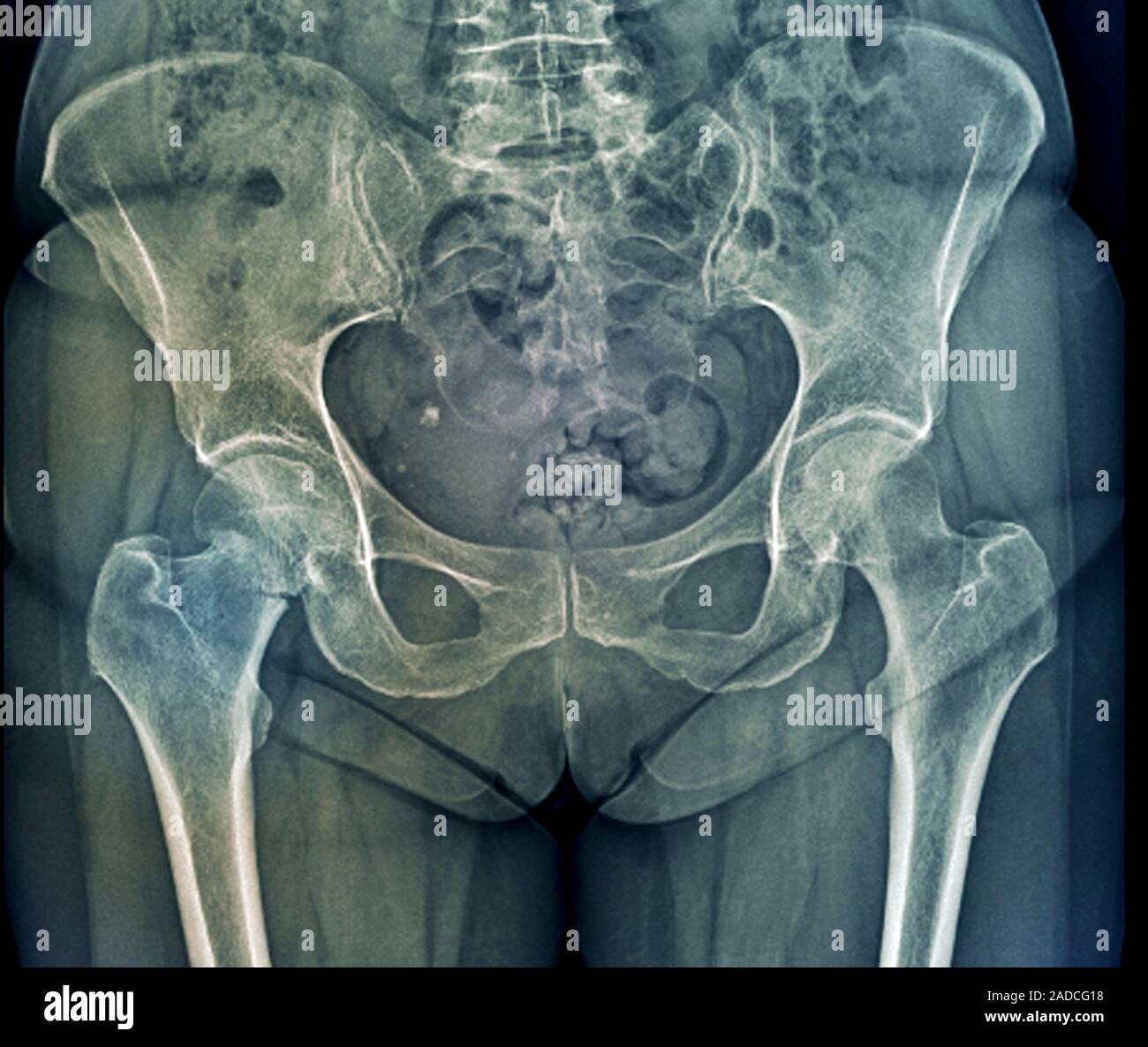 Hip fracture. Coloured frontal X-ray of the pelvic region of a 65-year ...