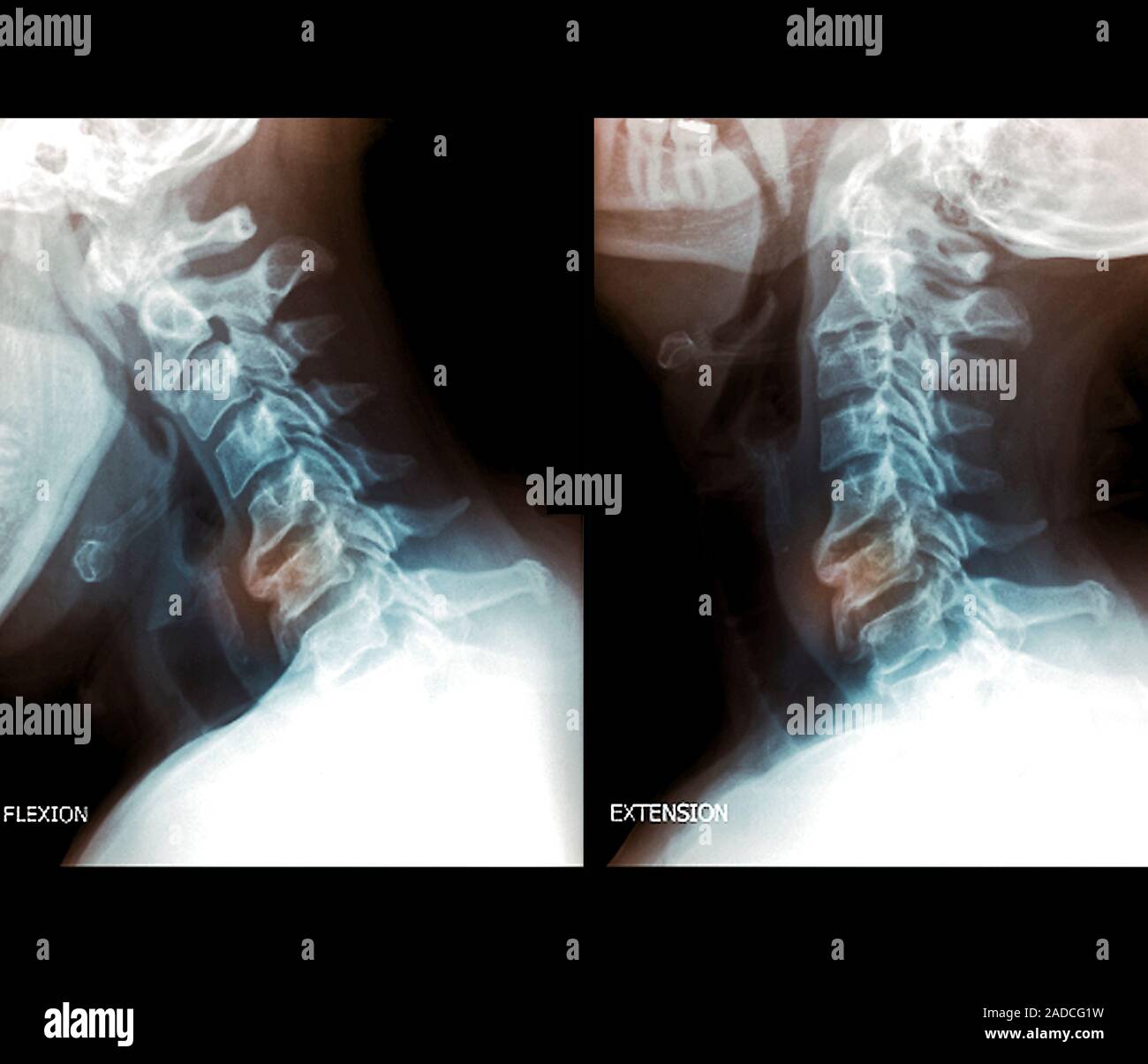 Osteoarthritis of the cervical spine. Coloured lateral Xrays of the
