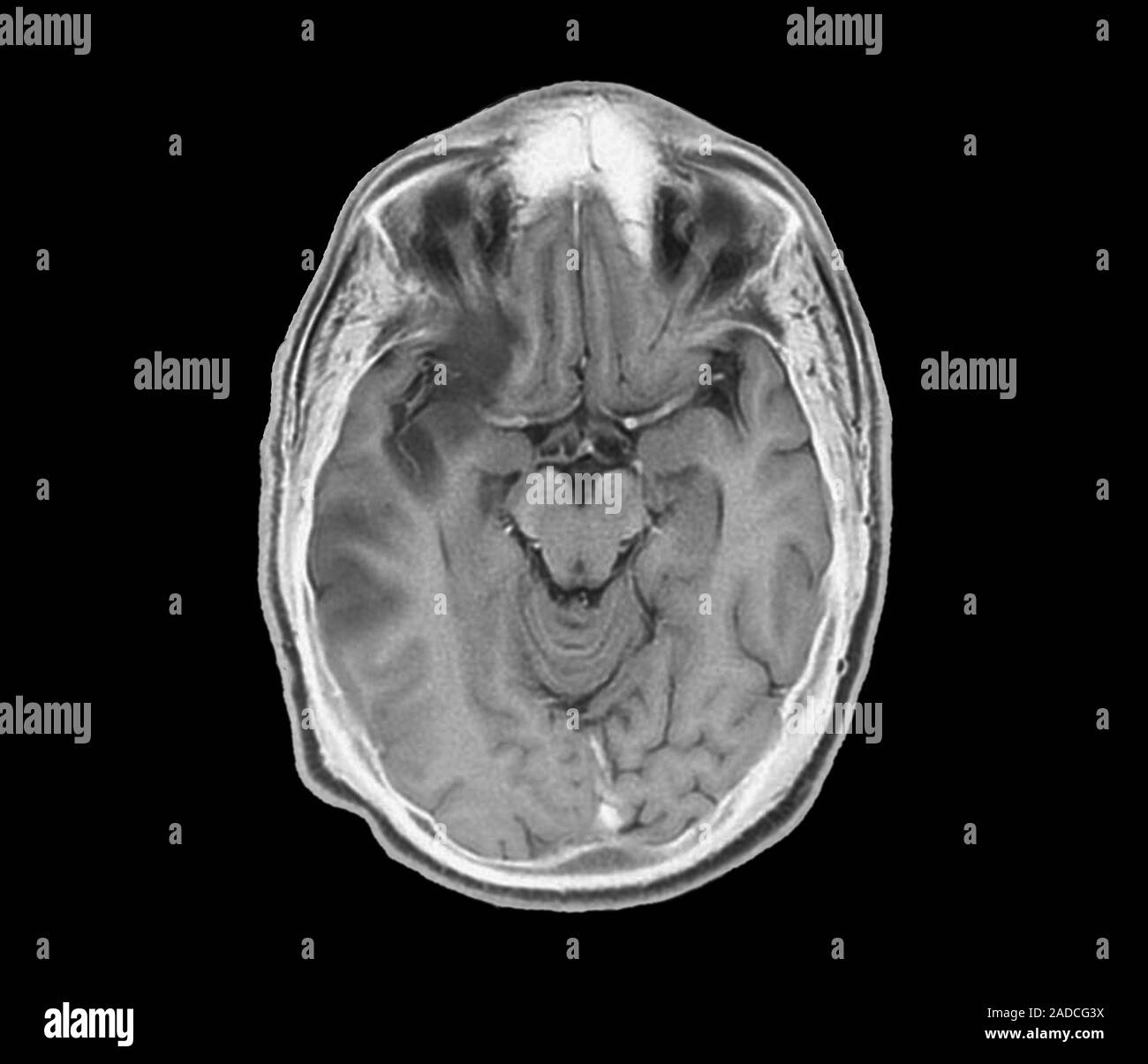Stroke. Axial magnetic resonance imaging (MRI) scan through the brain ...