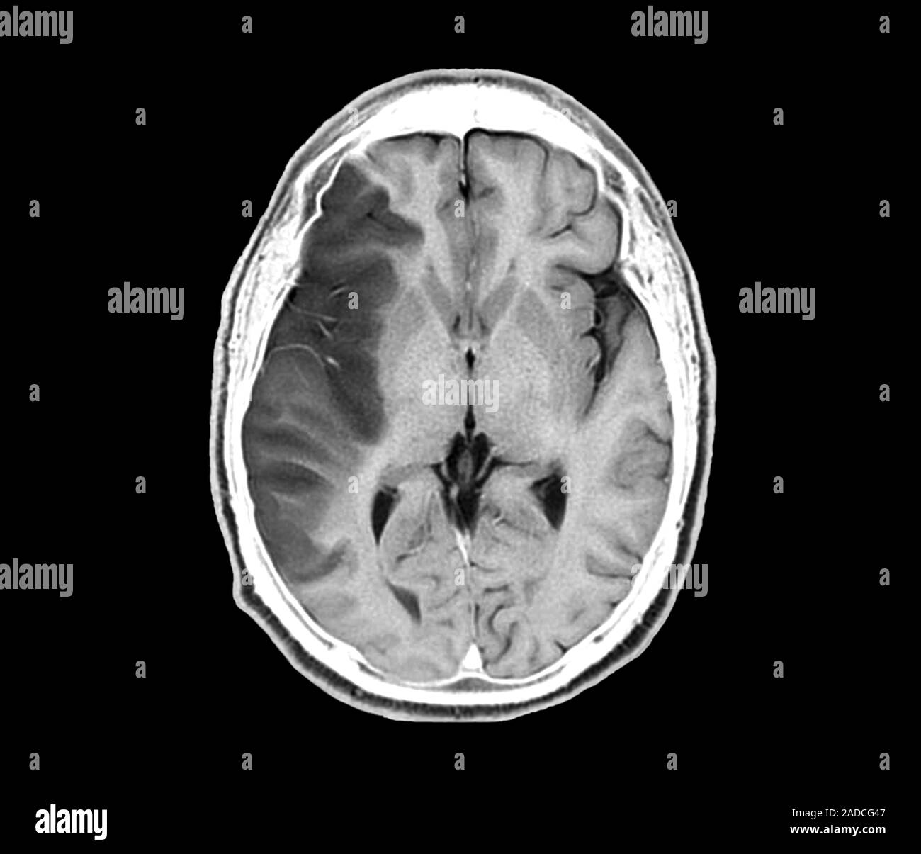 Stroke. Axial magnetic resonance imaging (MRI) scan through the brain ...