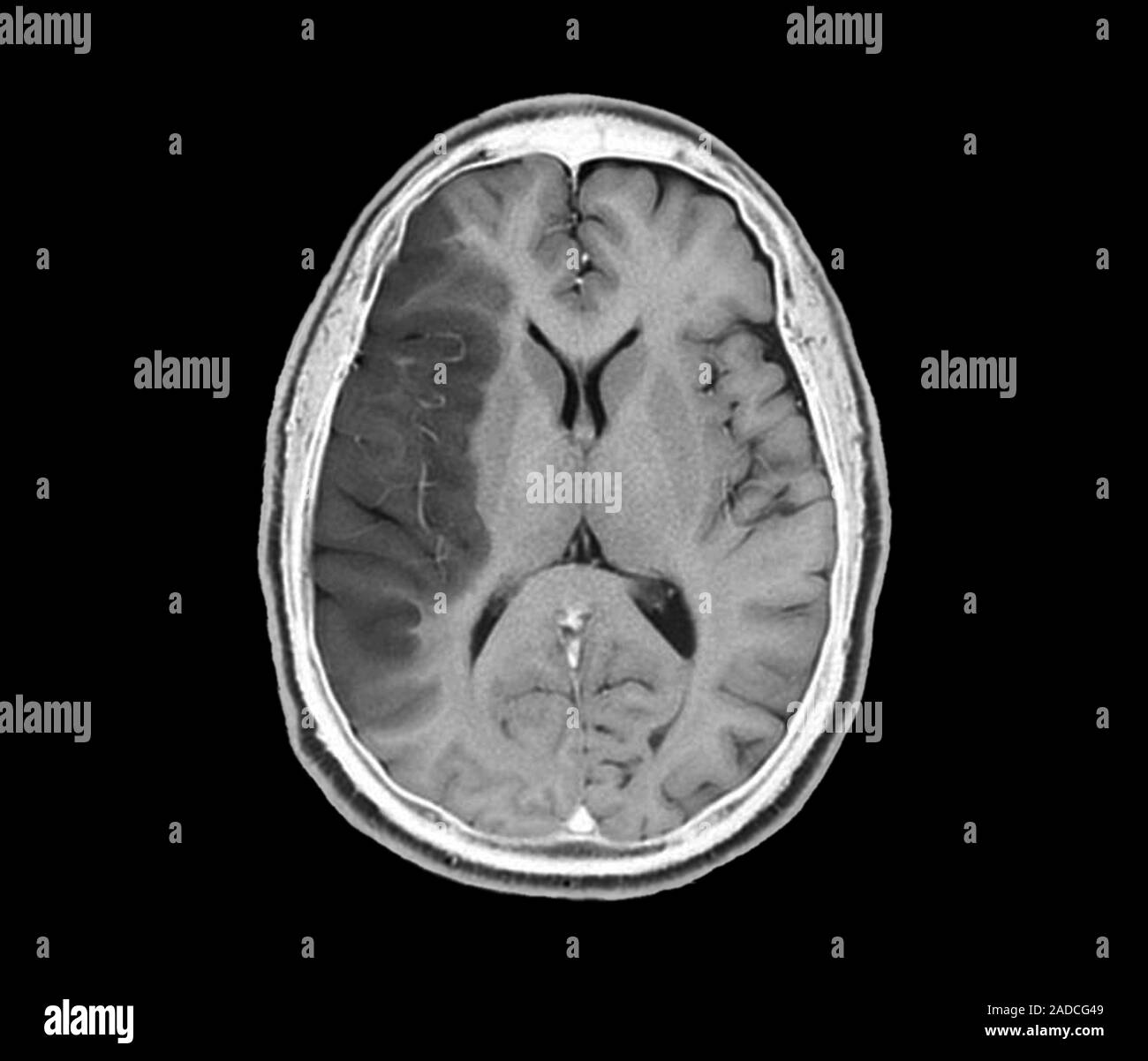 Stroke. Axial magnetic resonance imaging (MRI) scan through the brain ...