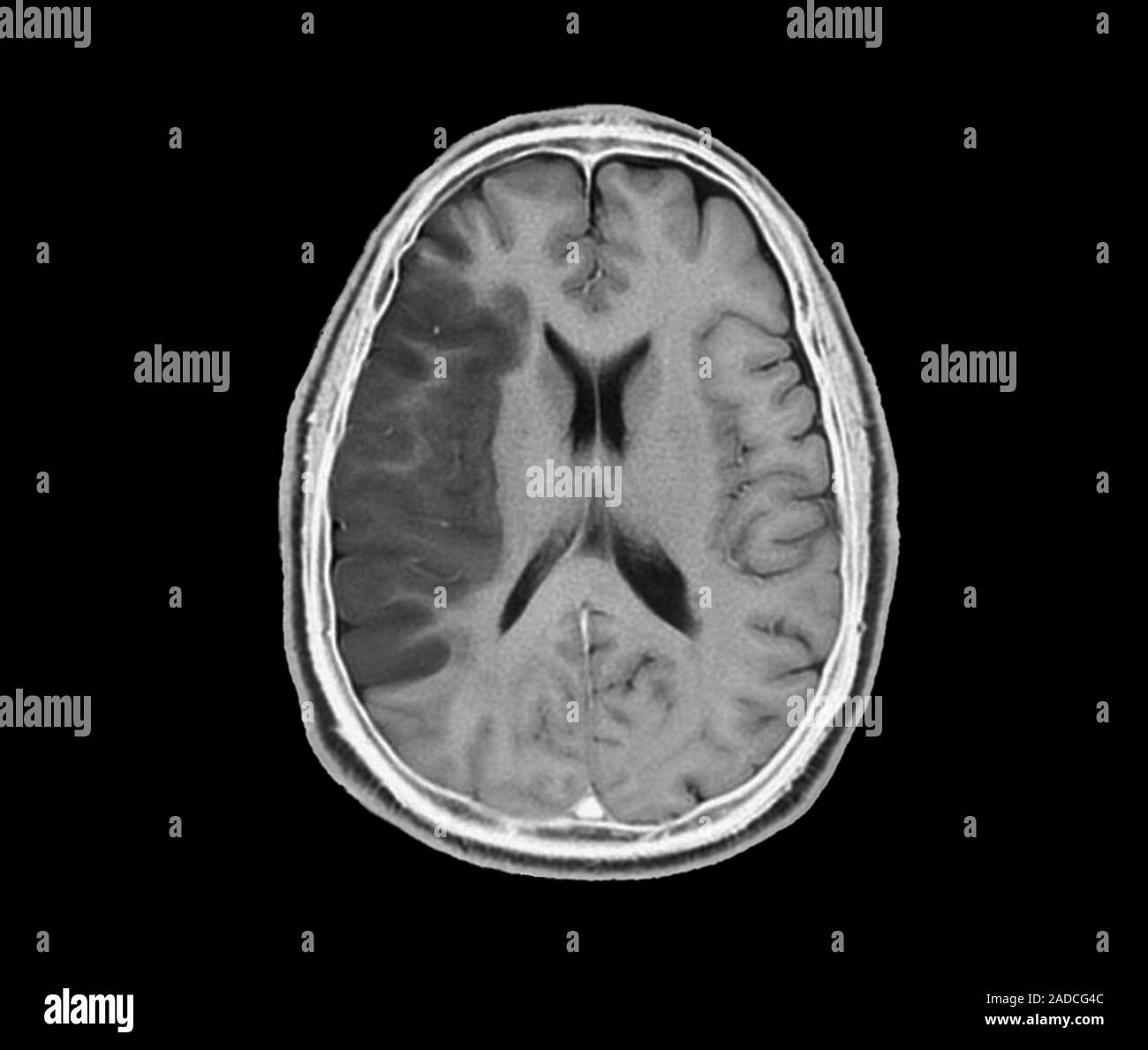 Stroke. Axial magnetic resonance imaging (MRI) scan through the brain ...