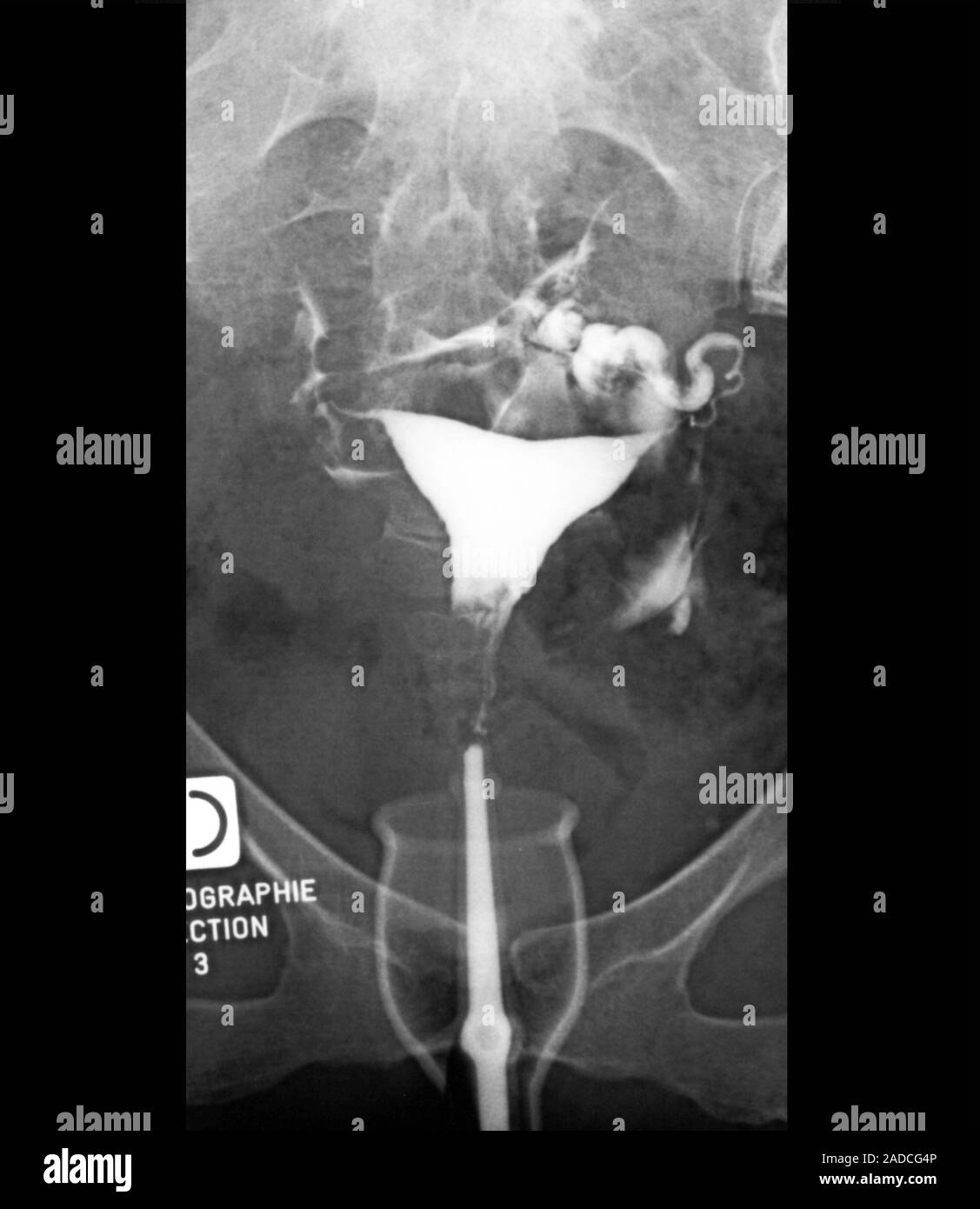 Retroverted uterus. Hysterosalpingogram (contrast medium Xray of the