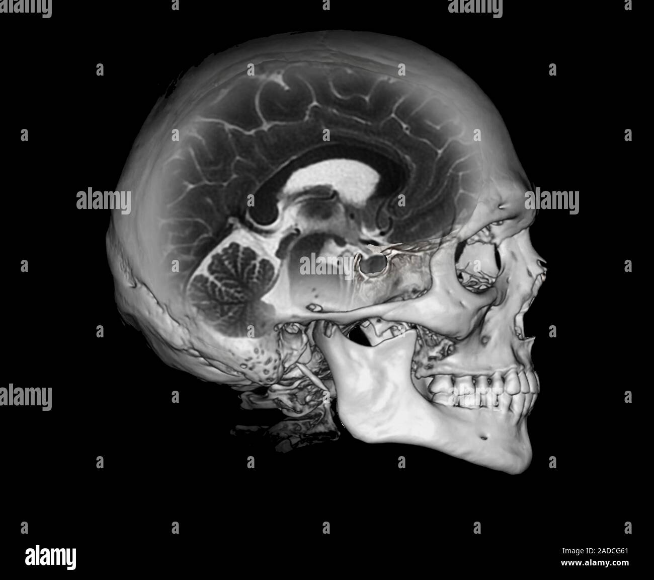 Human skull and brain. Combined computed tomography (CT) and