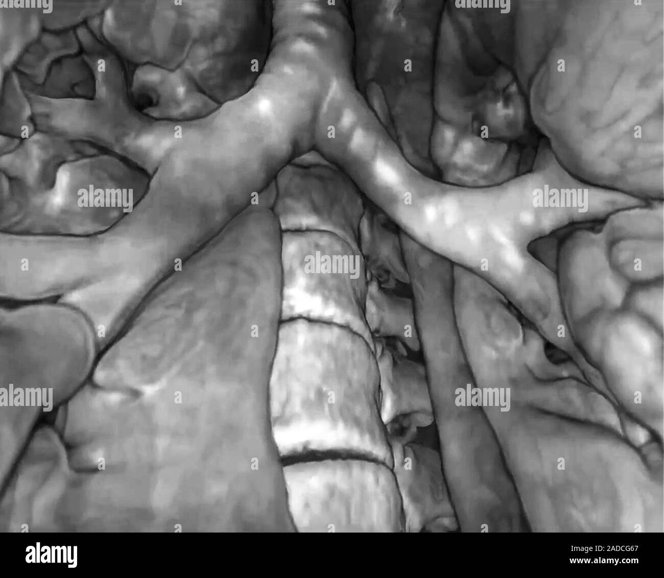 Bronchial divisions. 3D computed tomography (CT) scan of the primary ...