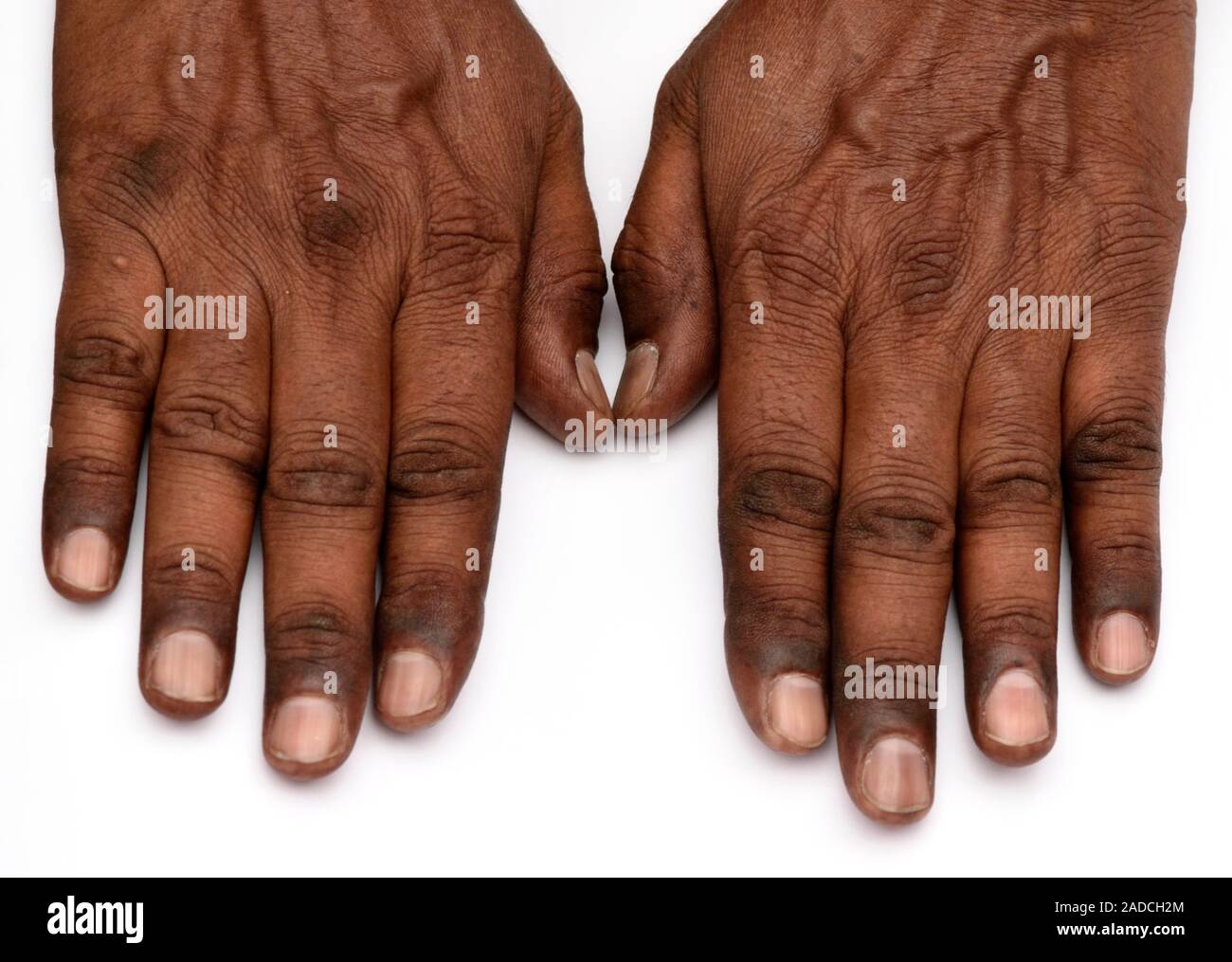 Not for use in Television Not for use in Television Pigmentation due to