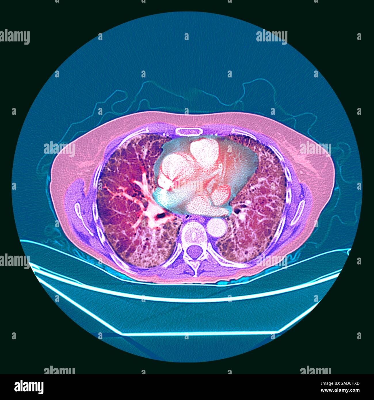 Pulmonary fibrosis. Coloured axial computed tomography (CT) scan of the chest of a 65yearold