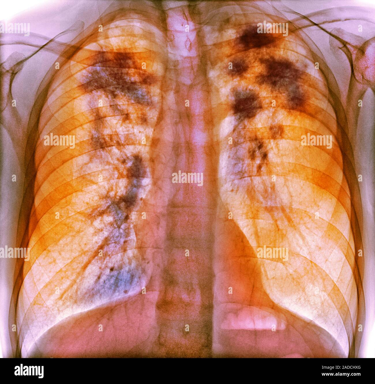 Sarcoidosis. Frontal coloured chest Xray of the lungs of a 52yearold