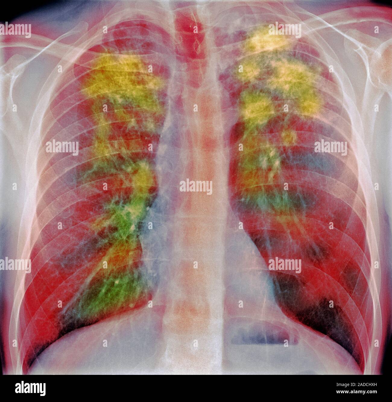 Sarcoidosis. Frontal coloured chest Xray of the lungs of a 52yearold