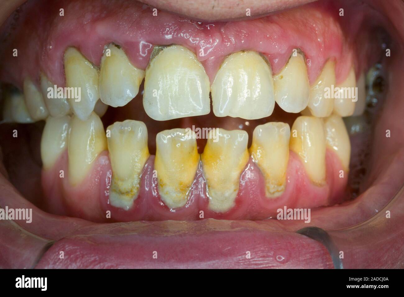 Tartar on teeth. Close-up of the lower and upper teeth of a 34 year old ...