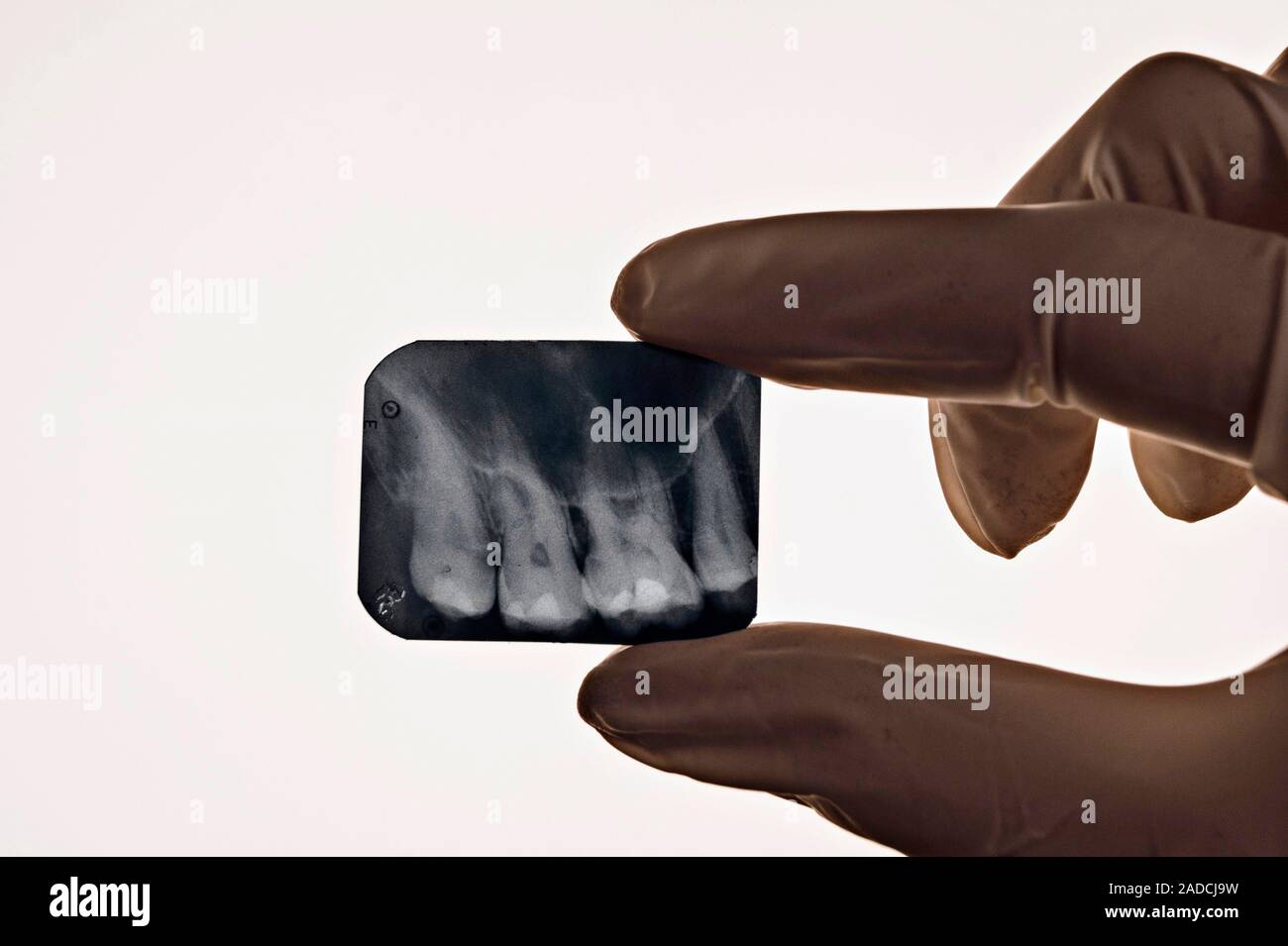 Dentist holding a dental Xray up to a lightbox. Fillings appear white