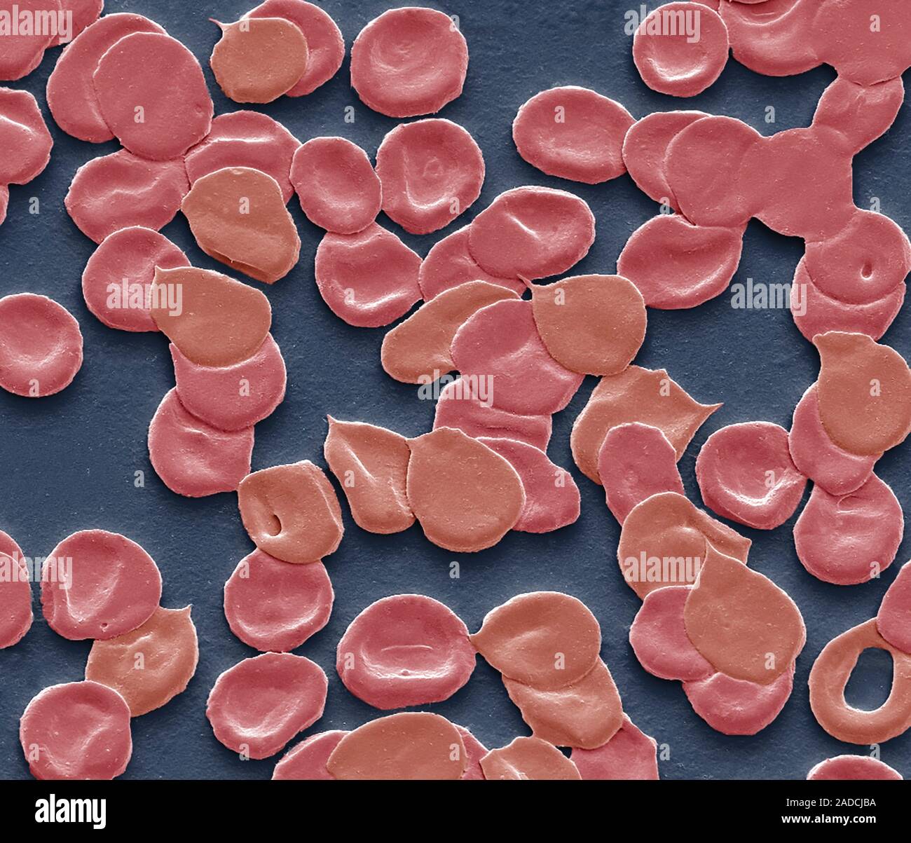 Iron deficiency anaemia. Colored scanning electron micrograph (SEM) of