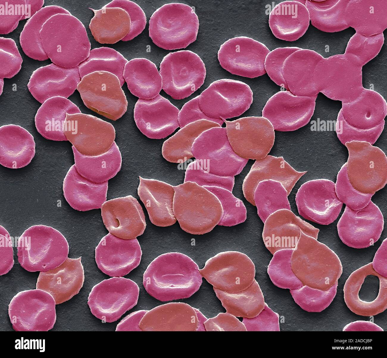 Iron deficiency anaemia. Scanning electron micrograph (SEM) of a blood