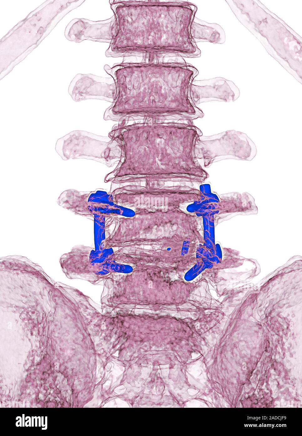 Spinal implant in lumbar fusion. Coloured frontal 3D computed