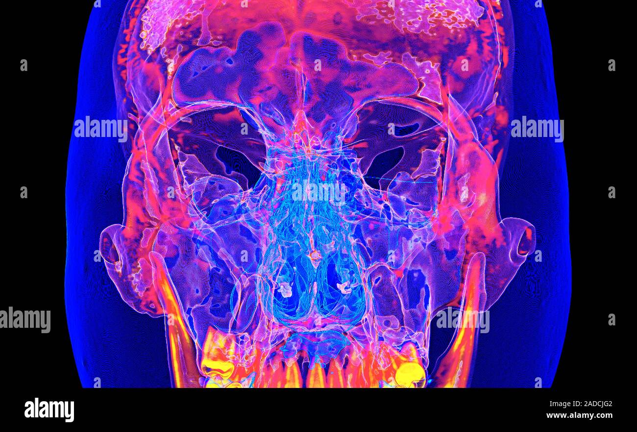 Facial bones of the skull. Coloured frontal 3D computed tomography (CT