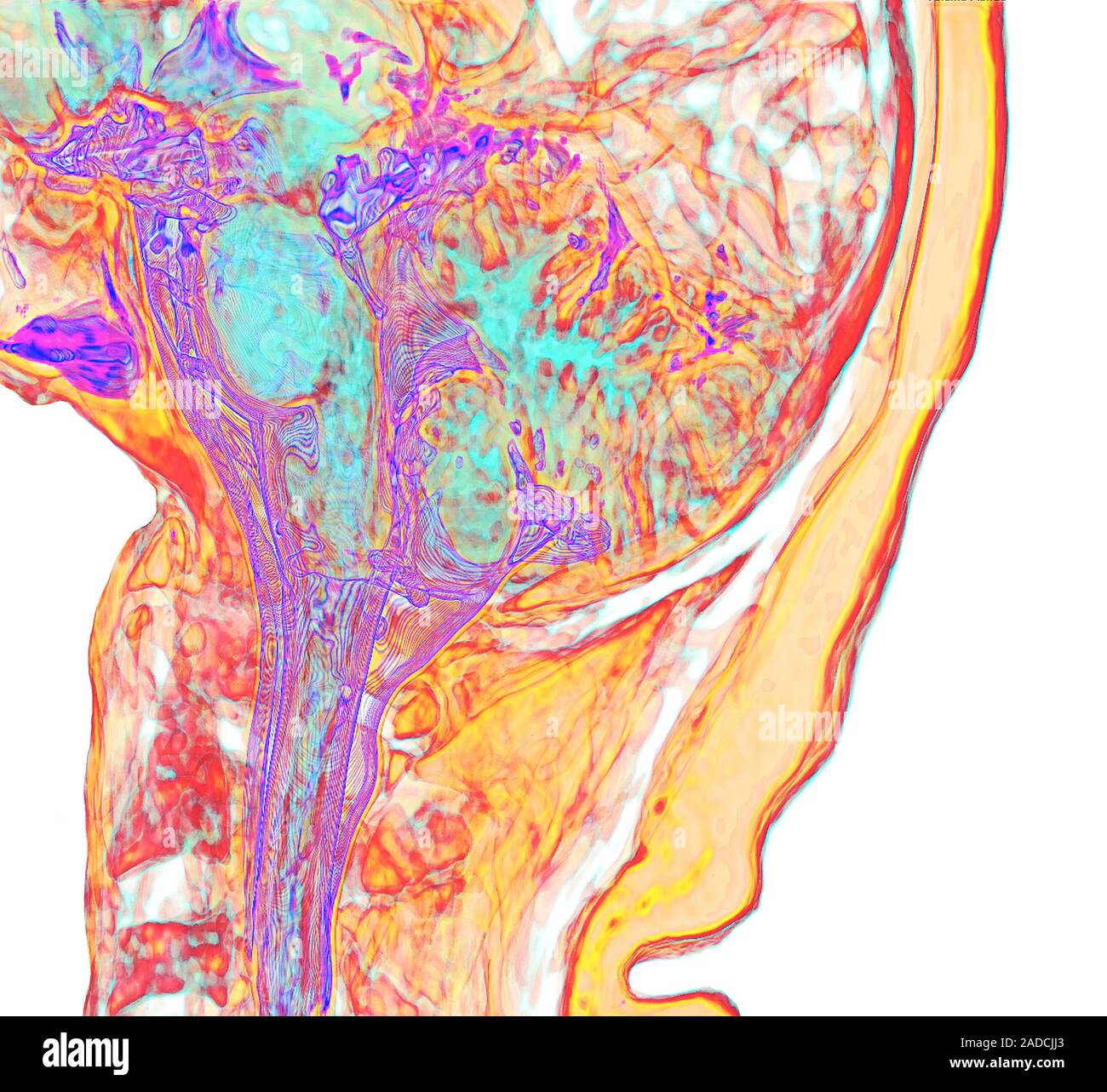 Rear of brain and spinal cord. Coloured sagittal resonance