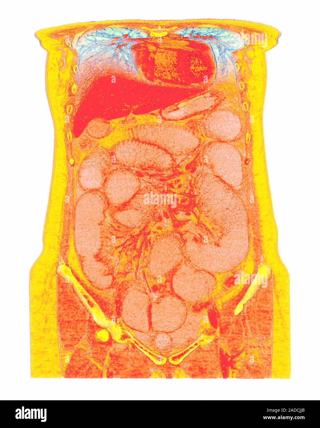 Intestinal obstruction. Coloured coronal computed tomography (CT) scan