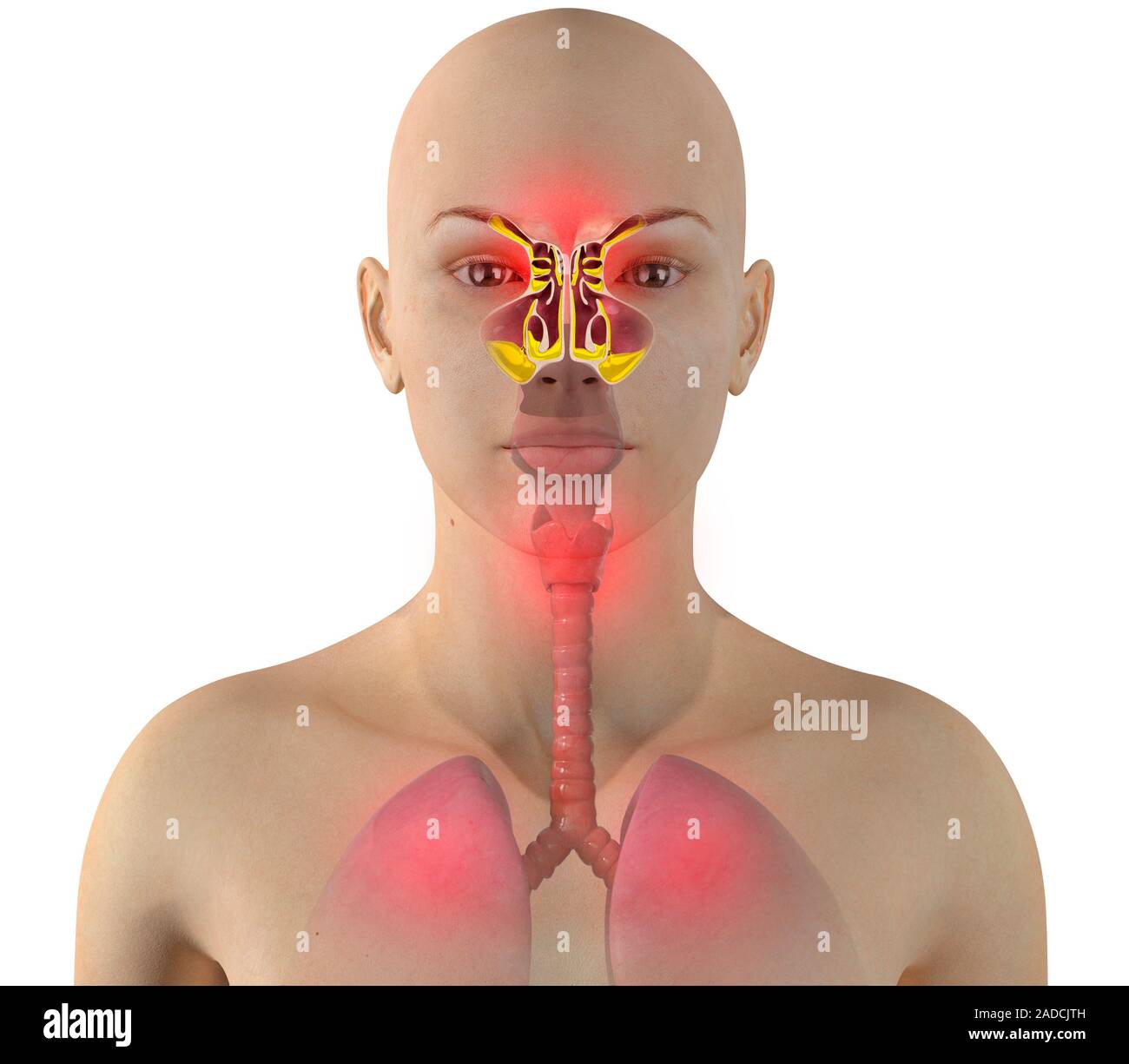 Sinus infection, or sinusitis, computer illustration. The sinuses are