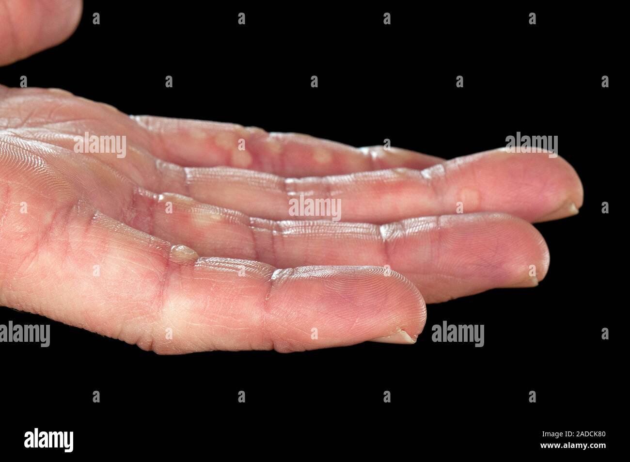 Common warts (verruca vulgaris) on the hand of a 35 year old male patient. Warts are harmless