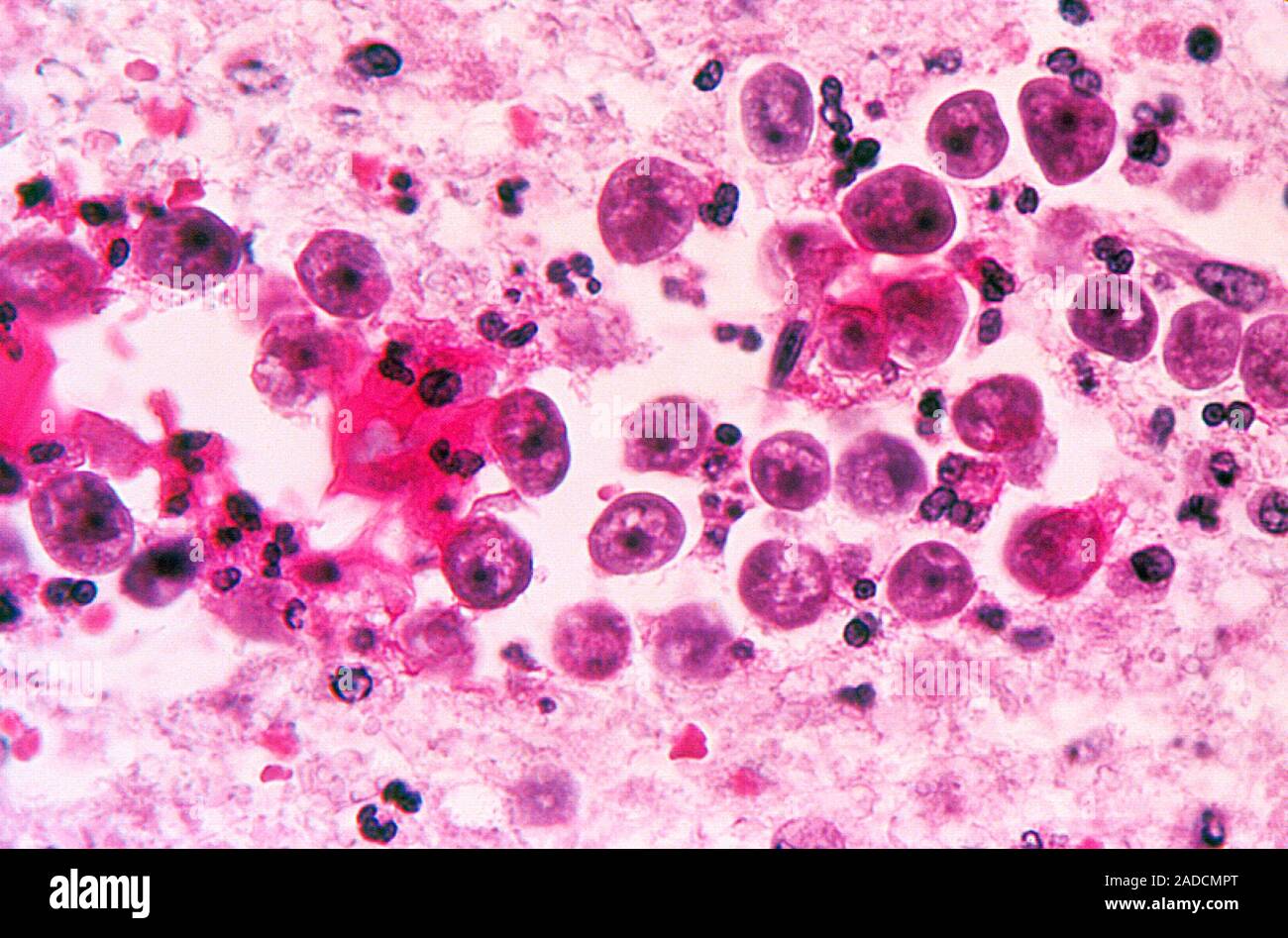 Naegleria fowleri amoeba infection. Light micrograph of a brain tissue