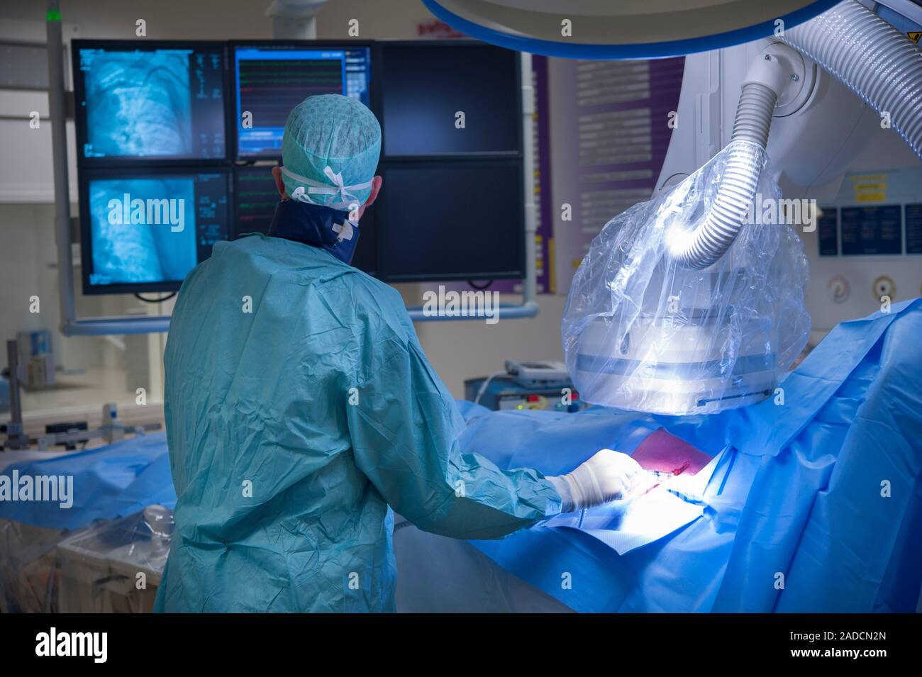 Implantable defibrillator surgery. Angiography being used during